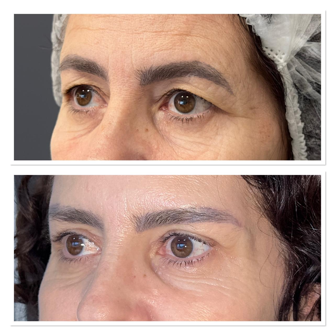Antes e depois — Caso 1 de blefaroplastia superior
