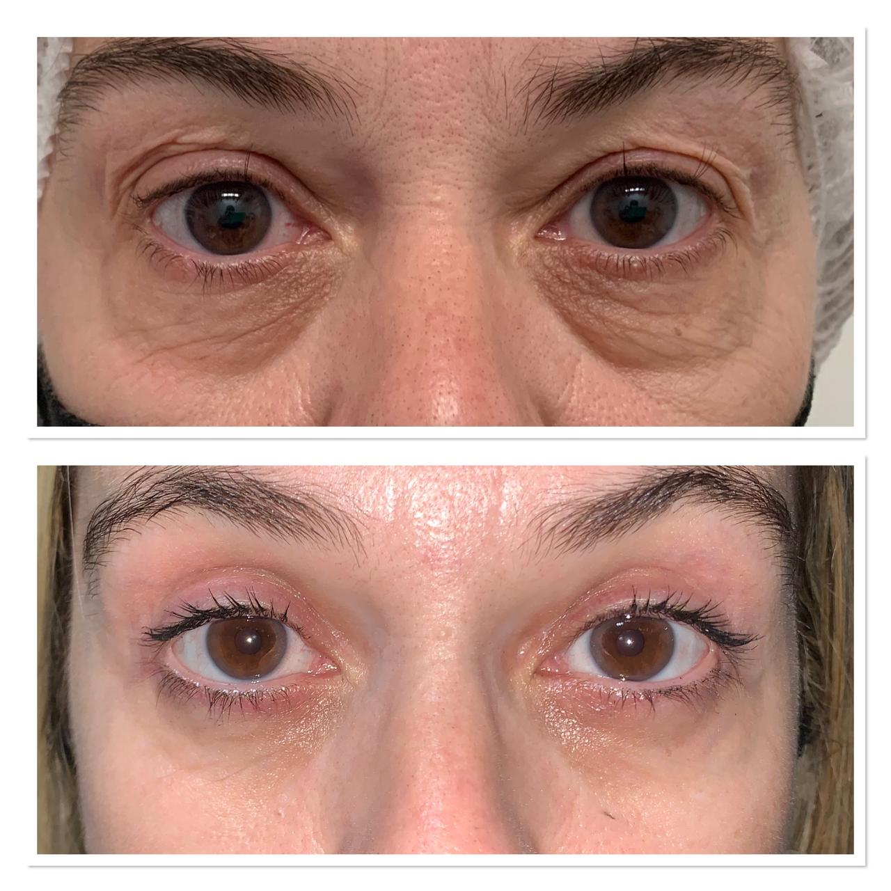 Antes e depois — Caso 2 de blefaroplastia superior
