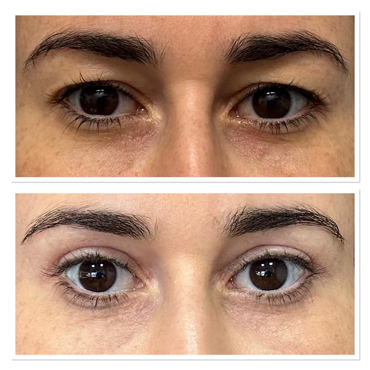 Antes e depois — Caso 3 de blefaroplastia superior